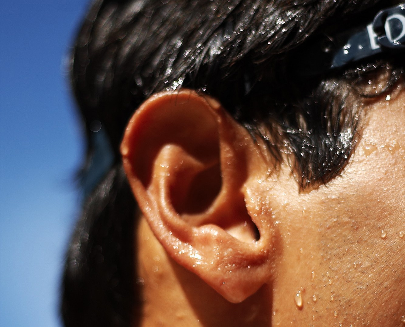 Viêm tai ngoài (Swimmer’s ear) mùa nắng nóng: Nhận biết dấu hiệu sớm và cách phòng ngừa