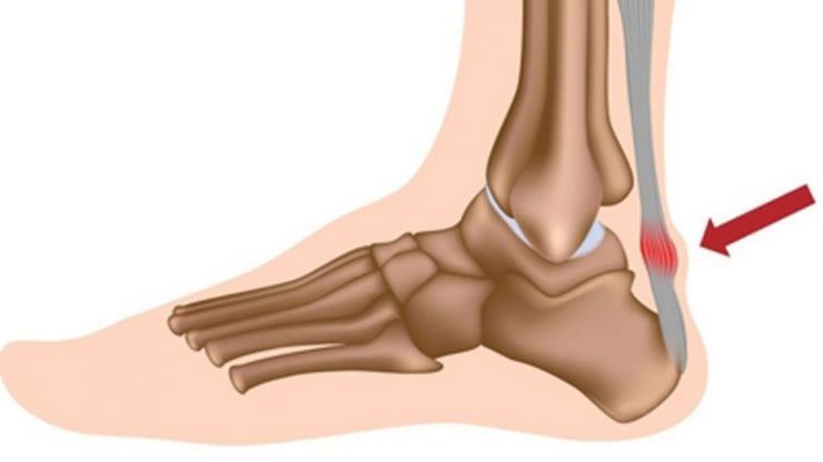 Đau gót chân là bệnh gì? Những điều cần biết về đau gót chân - Ảnh 1.