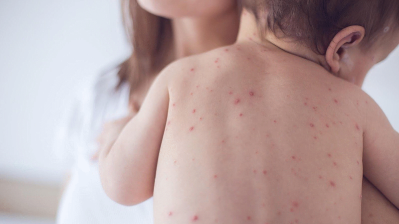 Tổng quan về các triệu chứng bệnh Rubella thường gặp mà bạn cần biết - Ảnh 2.