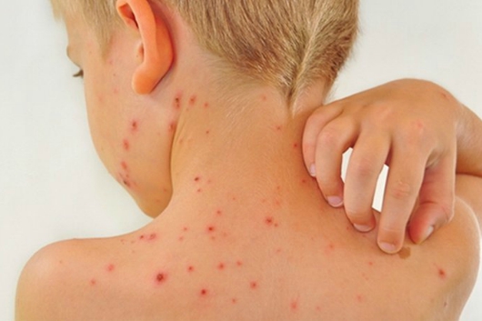 Những lưu ý khi chăm sóc và hỗ trợ điều trị bệnh Rubella  - Ảnh 1.