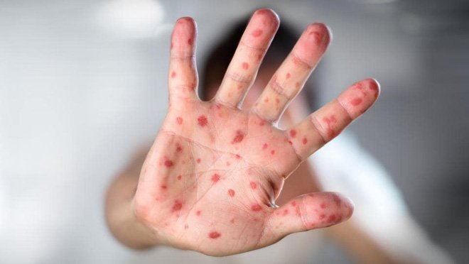 3 sai lầm khi chăm sóc người bệnh Rubella - Ảnh 2.