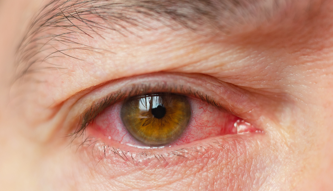 Khô mắt có phải triệu chứng của COVID-19 không? Nghiên cứu cho thấy điều gì? - Ảnh 2.