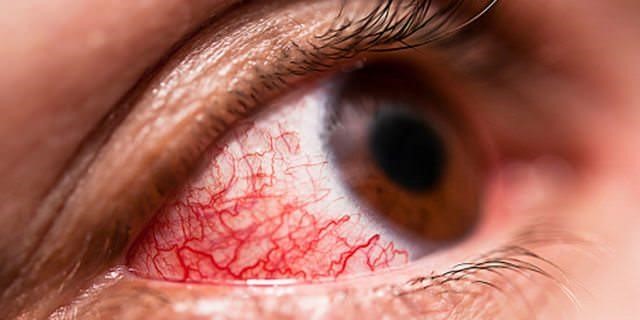Mắt bị đỏ tròng trắng là gì? Nguyên nhân và cách điều trị  - Ảnh 1.