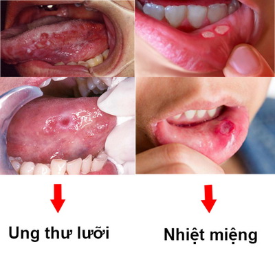 Ung thư lưỡi là gì? Tổng quan về căn bệnh ung thư lưỡi - Ảnh 5.