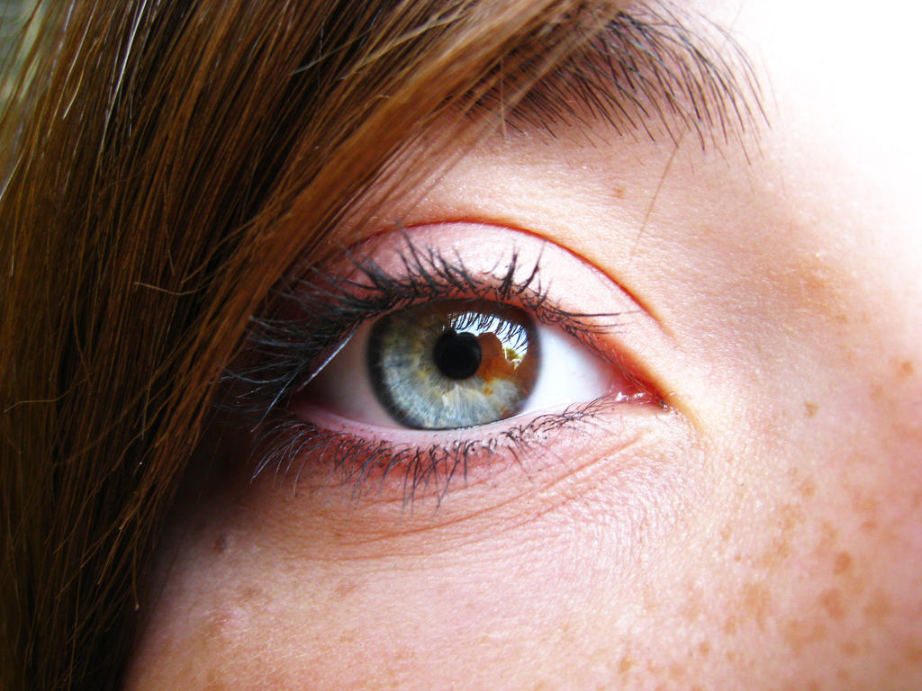 Loạn sắc tố mống mắt (Heterochromia Iridium): Nguyên nhân, dấu hiệu và cách điều trị - Ảnh 6.