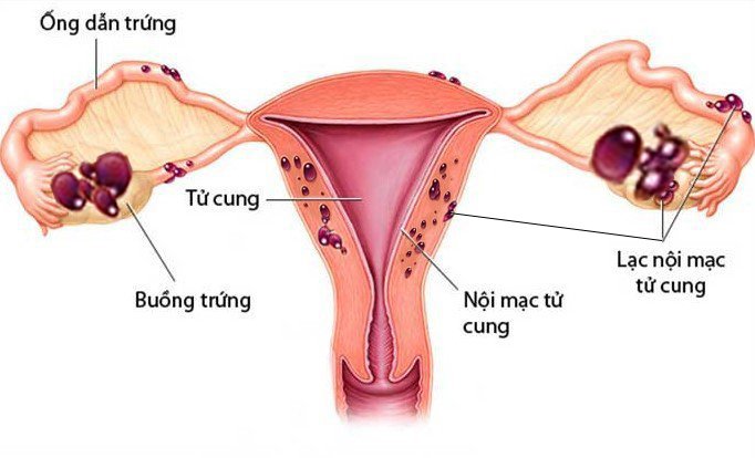 Lạc nội mạc tử cung ảnh hưởng khả năng sinh sản ở nữ - Ảnh 1.