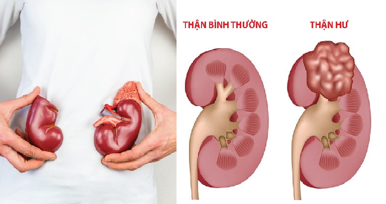 Giải đáp thắc mắc hội chứng thận hư có chữa khỏi được không? - Ảnh 2.