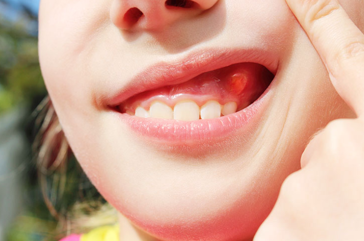 Phẫu thuật cắt chóp răng là gì? Cắt chóp răng có nguy hiểm không và bao lâu thì lành? - Ảnh 4.