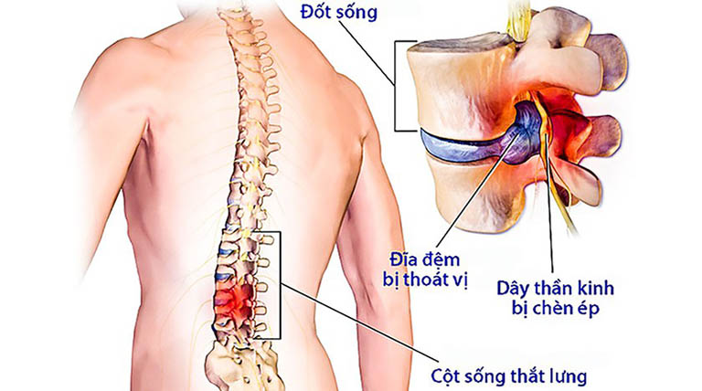 Thoát vị đĩa đệm có chữa được không? Các phương pháp điều trị hiệu quả nhất - Ảnh 2.