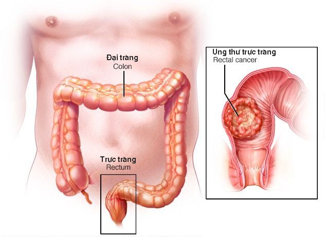 Tổng quan về bệnh ung thư trực tràng - Nguyên nhân, triệu chứng, cách điều trị - Ảnh 5.