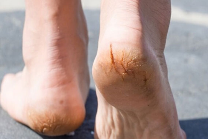Gót chân bị tróc da là bệnh gì? Làm thế nào để cải thiện? - Ảnh 3.