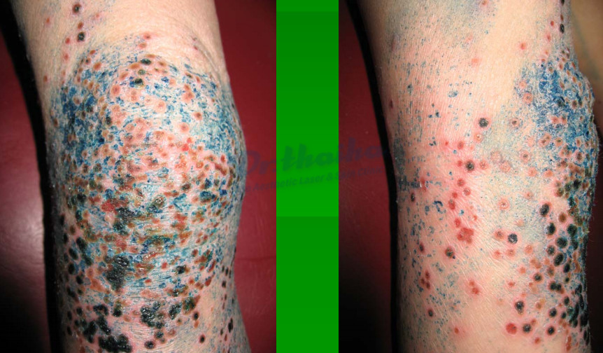 Chẩn Đoán Và Điều Trị Eczema Herpeticum