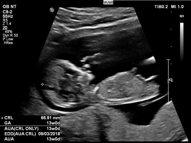  Ý nghĩa của các chỉ số thai nhi khi siêu âm mẹ bầu cần biết - Ảnh 2.