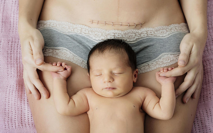 4 lỗi mẹ sinh mổ thường hay mắc dẫn đến thời gian phục hồi chậm và nguy cơ tai biến cao - Ảnh 1.