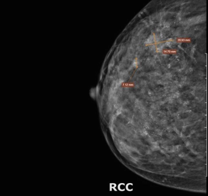 Chủ quan với khối u ở vú, người phụ nữ ngỡ ngàng phát hiện ung thư vú  - Ảnh 1.
