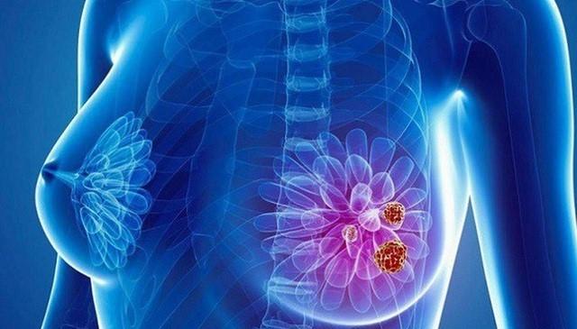 Chủ quan với khối u ở vú, người phụ nữ ngỡ ngàng phát hiện ung thư vú  - Ảnh 2.