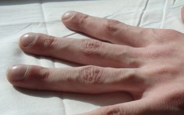 3 thay đổi này ở ngón tay có thể báo hiệu nhiều bệnh ung thư  - Ảnh 1.