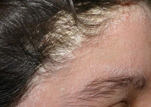 Cách chăm sóc tóc cho người bị nấm da đầu vào mùa đông - Ảnh 1.
