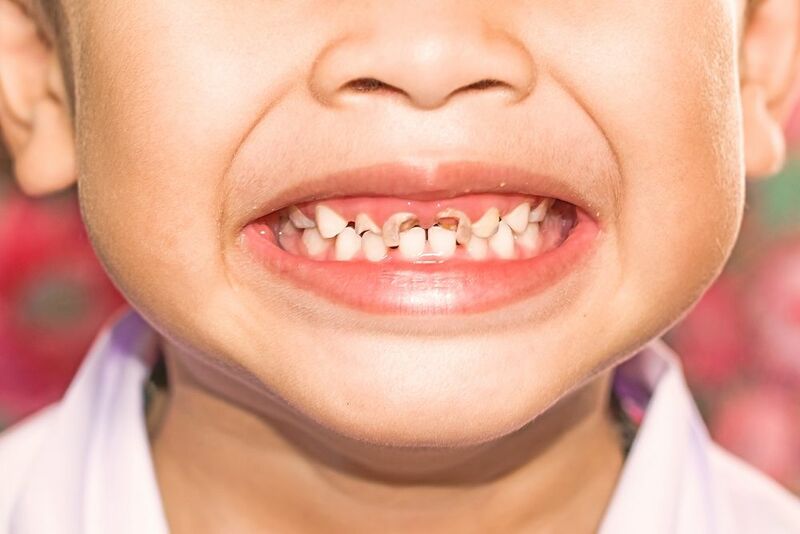 Nhổ răng sữa cho trẻ như thế nào để an toàn, bố mẹ có nên tự nhổ tại nhà cho con không? - Ảnh 3.