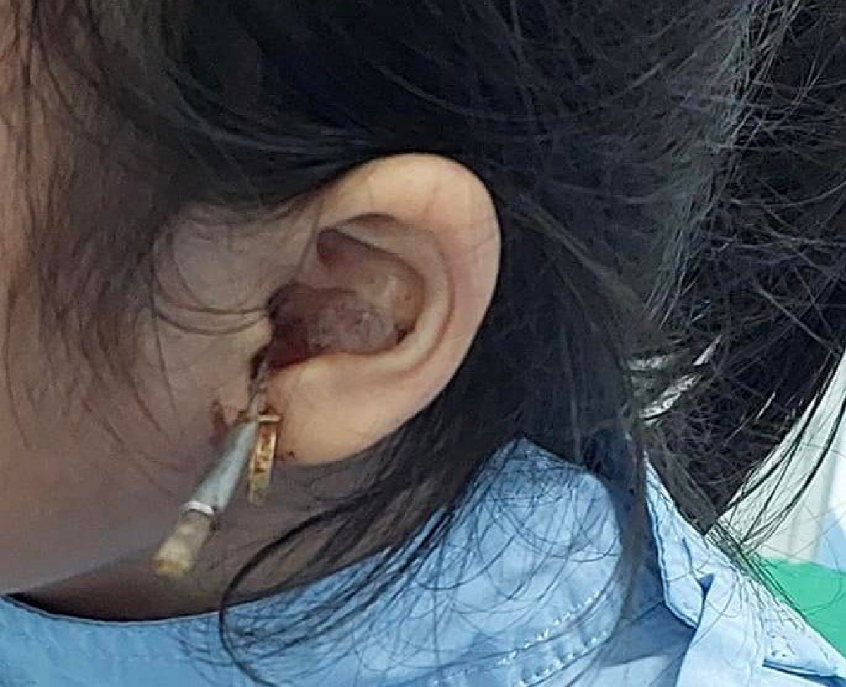 Từ vụ bé gái bị dị vật xuyên ống tai: Cách phát hiện và xử lý dị vật trong tai là gì? - Ảnh 2.