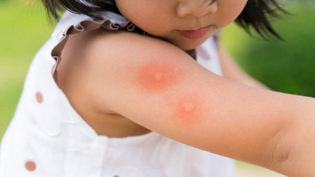 Trẻ bị sốt xuất huyết: Áp dụng một trong 4 cách sau sẽ nhanh khỏi bệnh tại nhà - Ảnh 4.