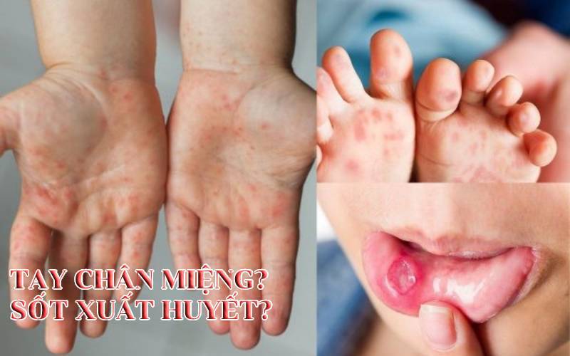 Trẻ có thể bị tay chân miệng và sốt xuất huyết cùng lúc không?