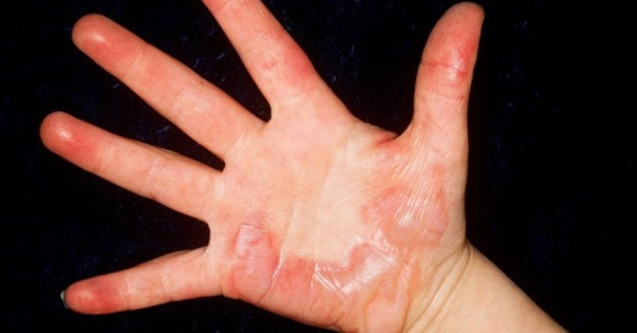 Nguyên nhân lòng bàn tay nổi đốm đỏ là gì? Cách điều trị như thế nào? - Ảnh 2.