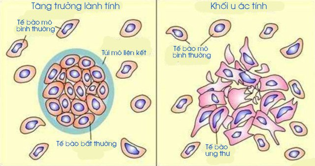 Biểu hiện của khối u ác tính? Khối U ác tính có phải là ung thư không? - Ảnh 2.