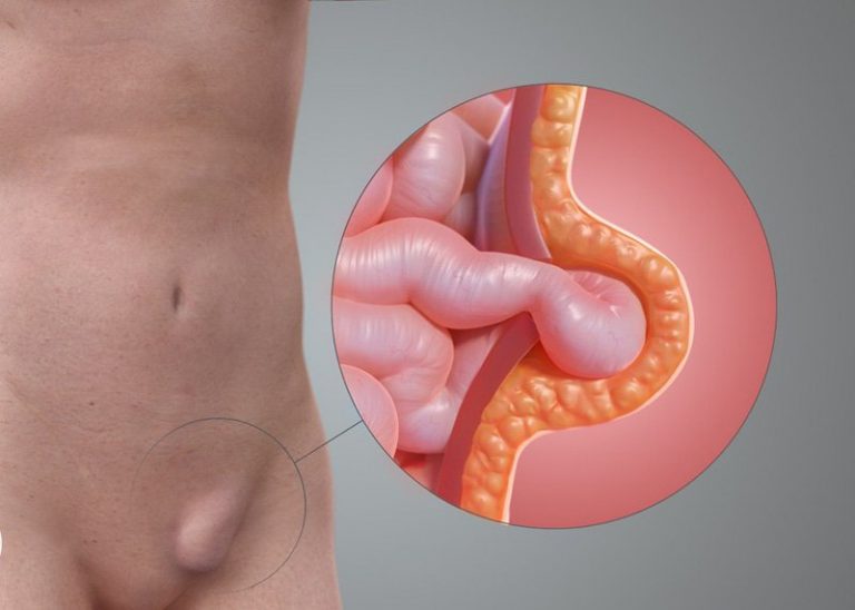 Bị đau bụng dưới bên phải gần háng ở nam giới là bệnh gì? - Ảnh 2.