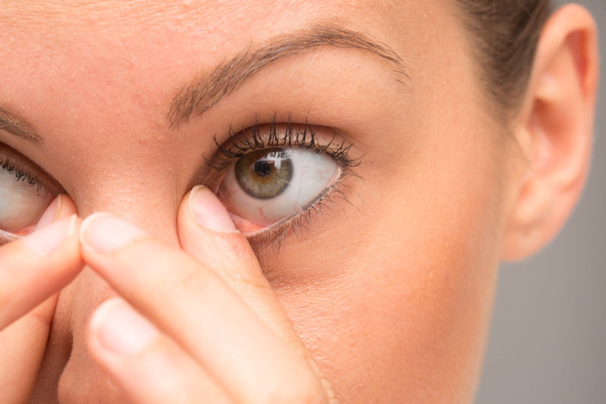 Nhiều người làm động tác này để giảm mỏi mắt mà không biết có thể gây biến dạng nhãn cầu - Ảnh 2.
