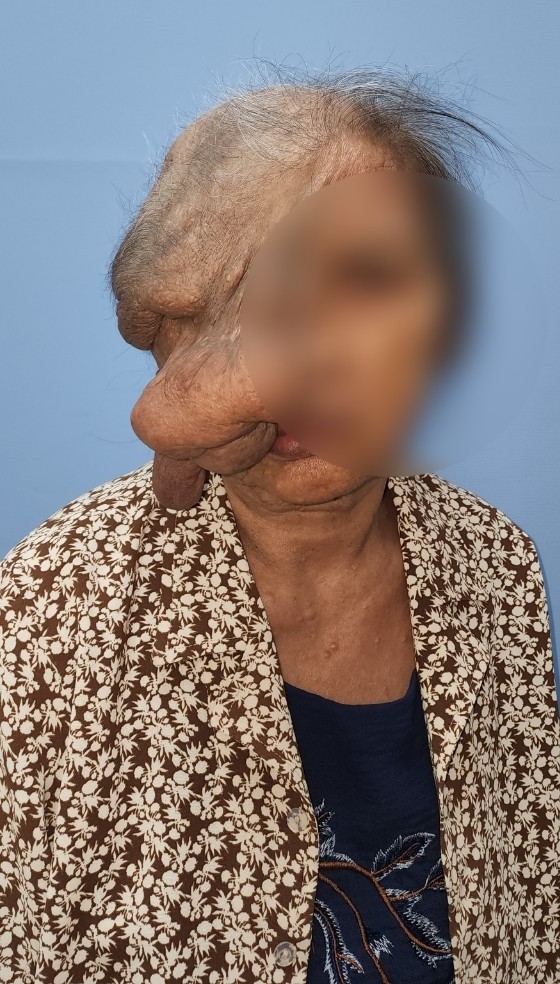 Giải phóng khối u &quot;quái&quot; khủng trên mặt cụ bà 73 tuổi, Thủ tướng gửi thư khen - Ảnh 1.