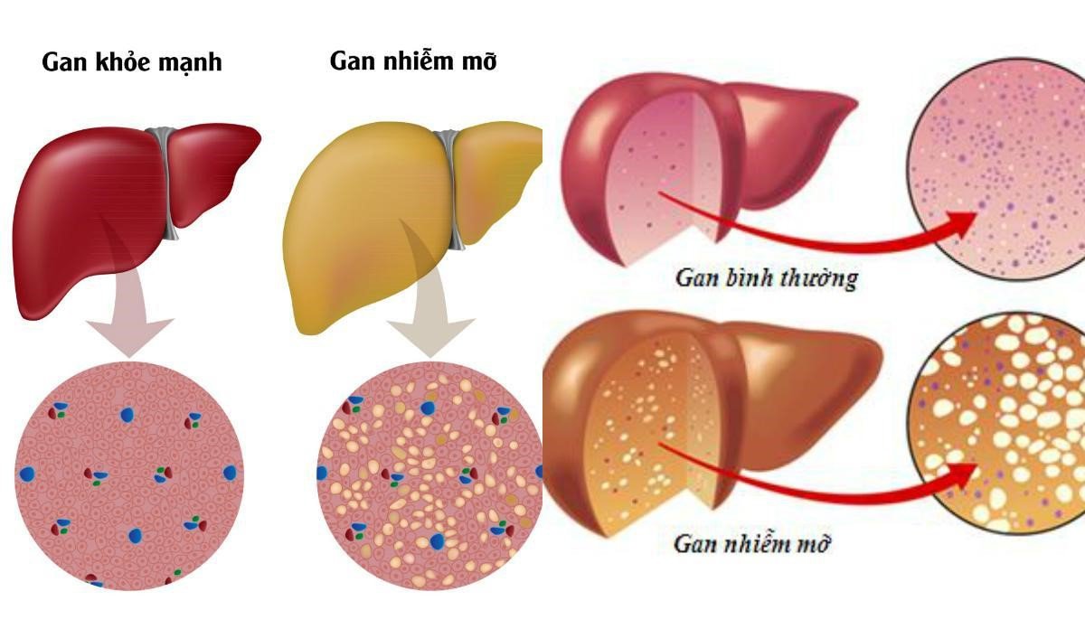 4. Nguyên nhân gây tăng chỉ số GPT