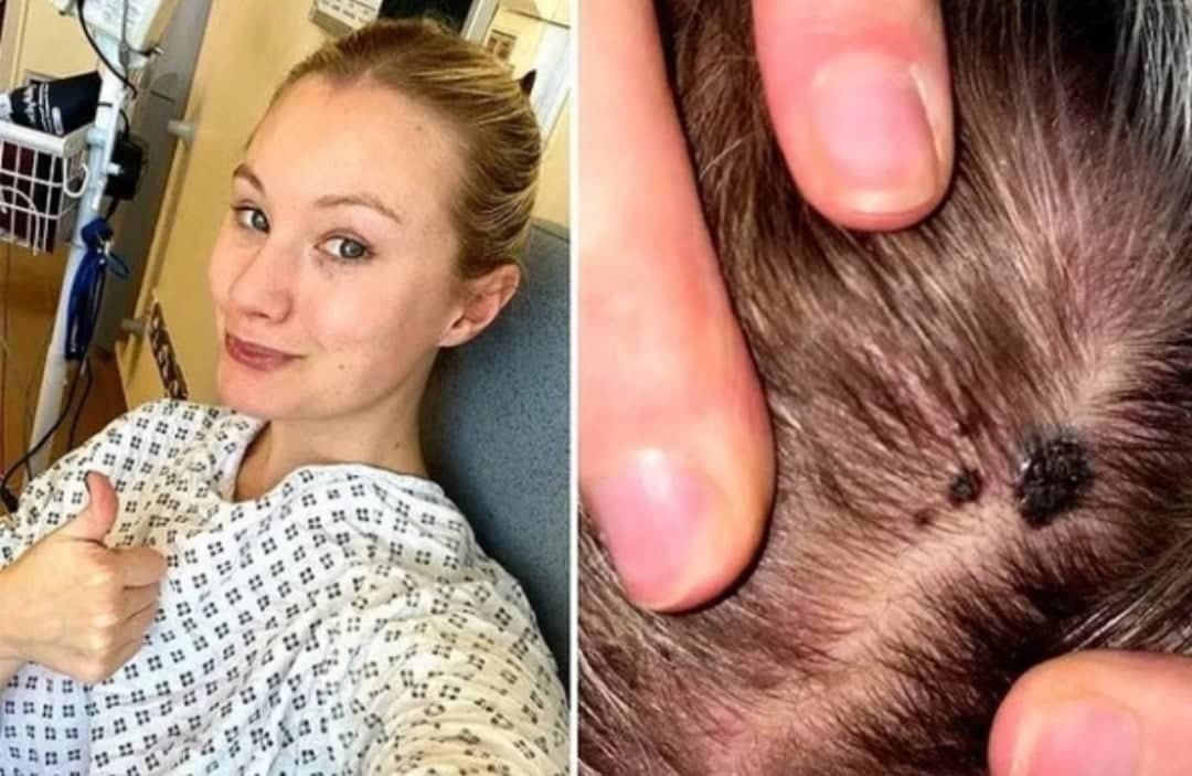 Cô gái 29 tuổi phát hiện mắc ung thư từ nốt ruồi đen trên đỉnh đầu: &quot;Xin đừng coi thường tác hại của ánh nắng mặt trời&quot; - Ảnh 1.