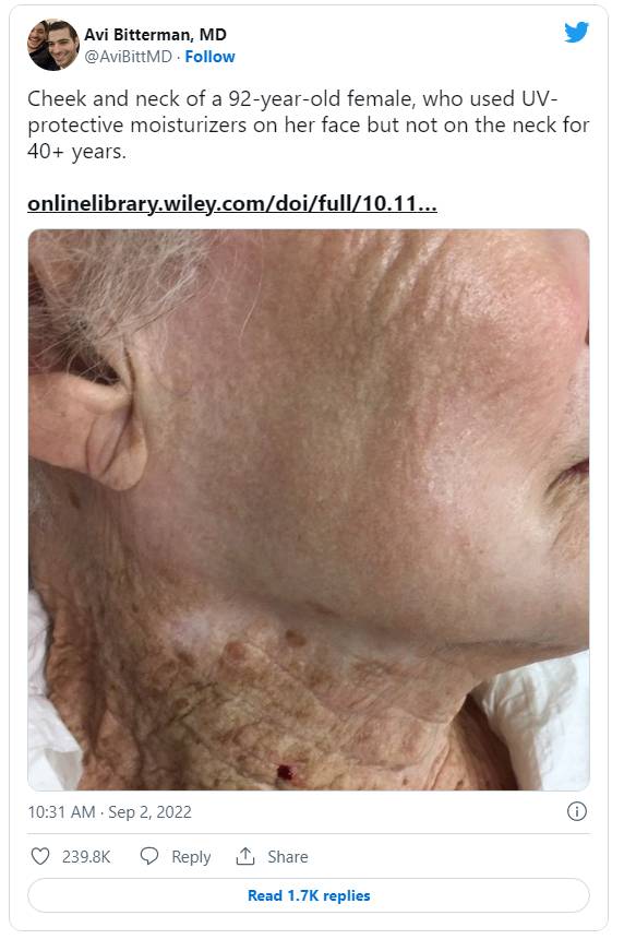 Bức ảnh của người người phụ nữ 92 tuổi này là lời nhắc nhở nghiêm khắc về việc dùng kem chống nắng - Ảnh 2.