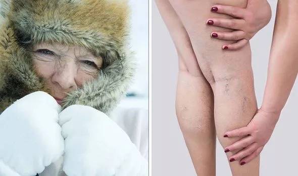 Người phụ nữ mất cả hai chân vì cục máu đông: Cảnh giác với những dấu hiệu đầu tiên của bệnh - Ảnh 3.