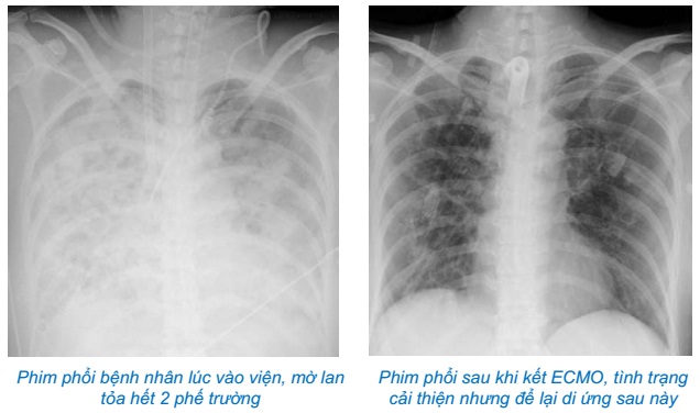 Tự chữa bệnh cúm, nữ bệnh nhân phải chạy tim phổi nhân tạo 37 ngày - Ảnh 1.