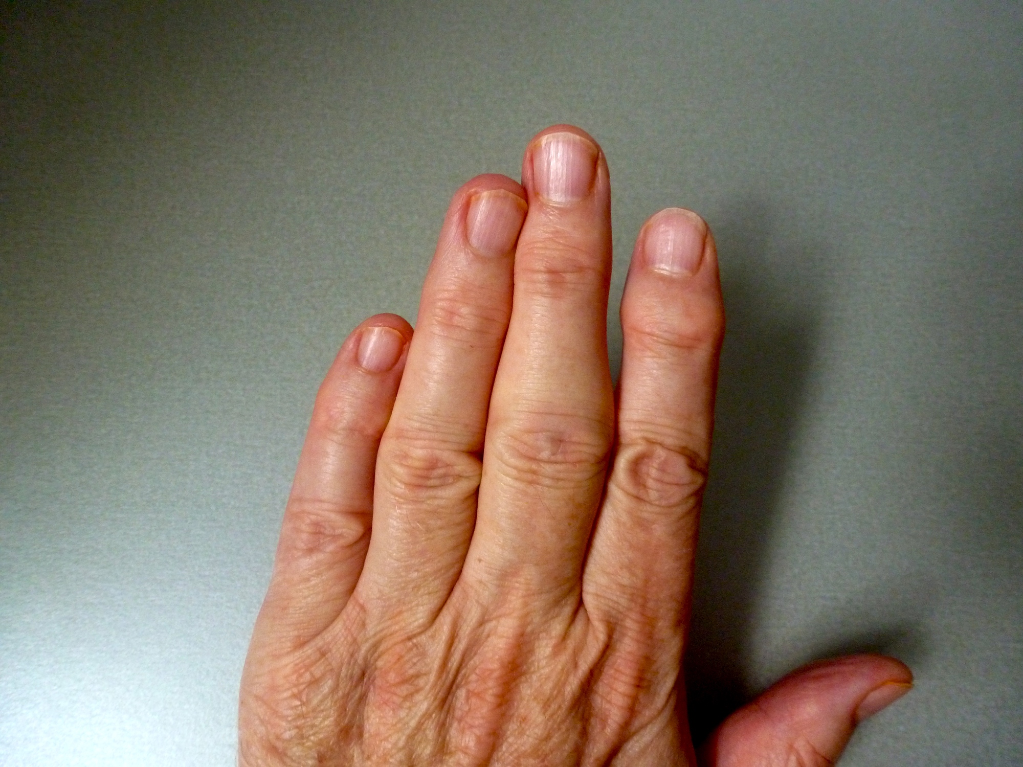 Khớp ngón tay bị sưng đau không chỉ do viêm khớp- Ảnh 2.