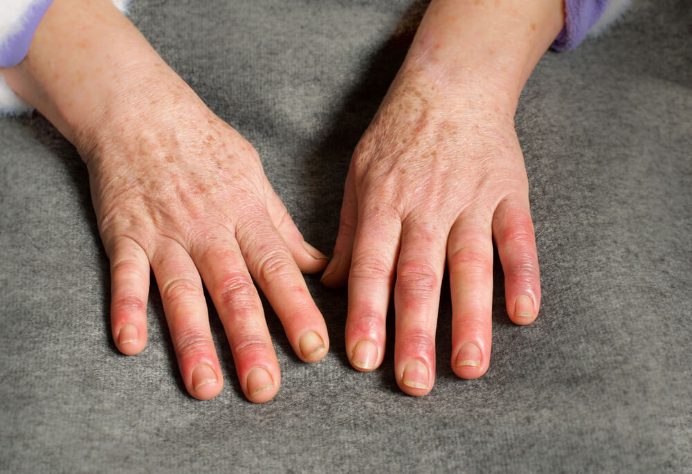 Khớp ngón tay bị sưng đau không chỉ do viêm khớp- Ảnh 3.