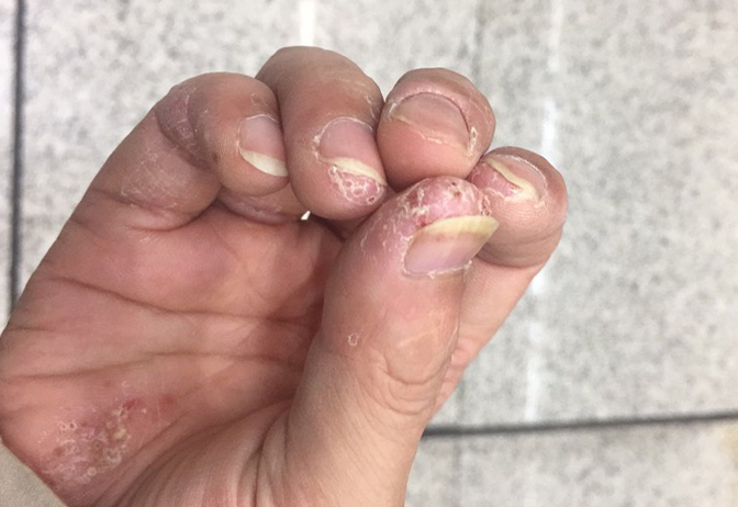 Bong tróc da đầu ngón tay: Nguyên nhân, cách điều trị và phòng ngừa- Ảnh 3.