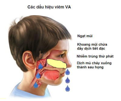 Dấu hiệu viêm VA điển hình bạn cần biết - Ảnh 2.