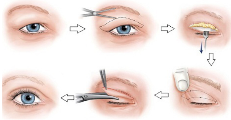 4 cách tốt nhất giúp chị em sở hữu mắt 2 mí đẹp tự nhiên - Ảnh 4.