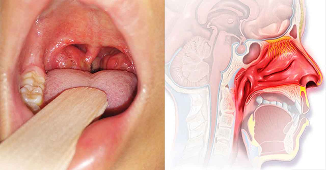 3. Triệu Chứng Của Viêm VA Ở Người Lớn