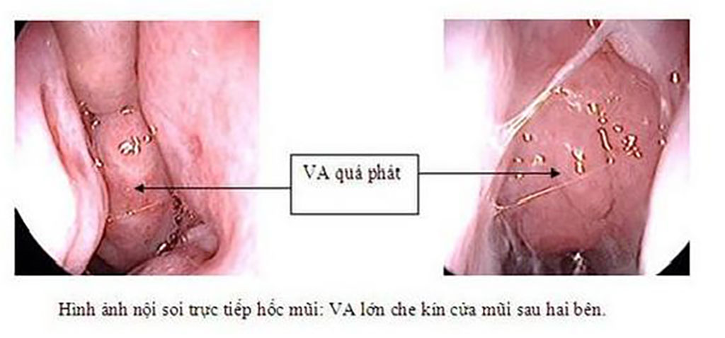 Biến chứng và những lưu ý khi điều trị viêm VA