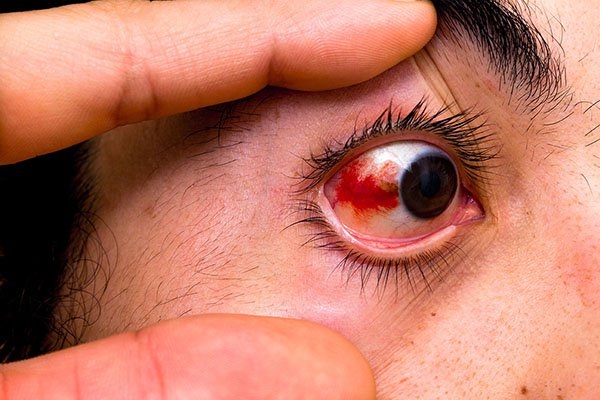 Cô gái 20 tuổi suýt mù lòa vì dụi mắt, bác sĩ nhắc nhở những việc cần làm để bảo vệ mắt khi giao mùa - Ảnh 2.