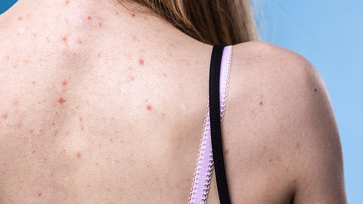 how-to-treat-back-acne-722x406-167903218