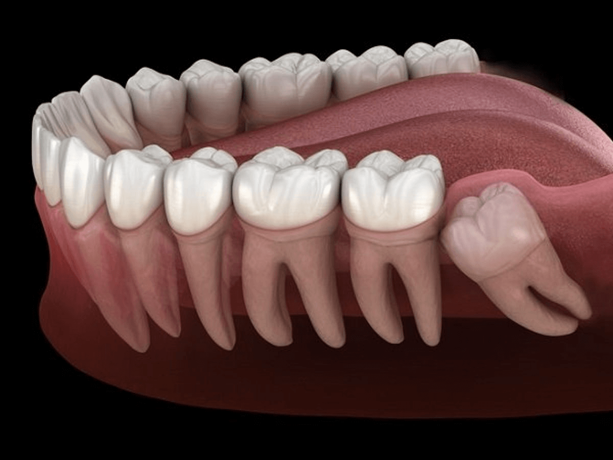 Nhổ răng khôn an toàn: Tiết lộ quy trình thực hiện tránh biến chứng - Ảnh 1.