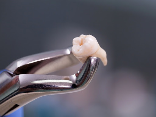 Nhổ răng khôn an toàn: Tiết lộ quy trình thực hiện tránh biến chứng - Ảnh 4.