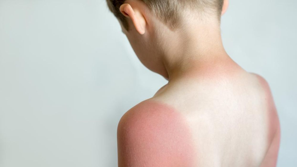 10 tình trạng gây phát ban và sẩn ngứa da mùa hè ở trẻ - Ảnh 11.