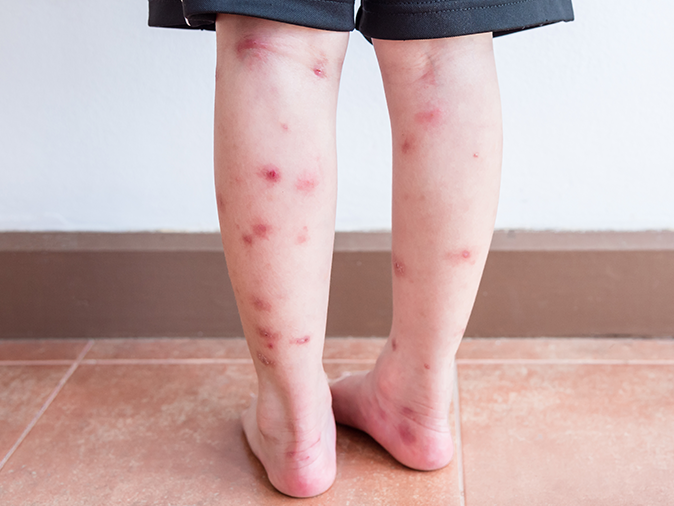 10 tình trạng gây phát ban và sẩn ngứa da mùa hè ở trẻ - Ảnh 3.