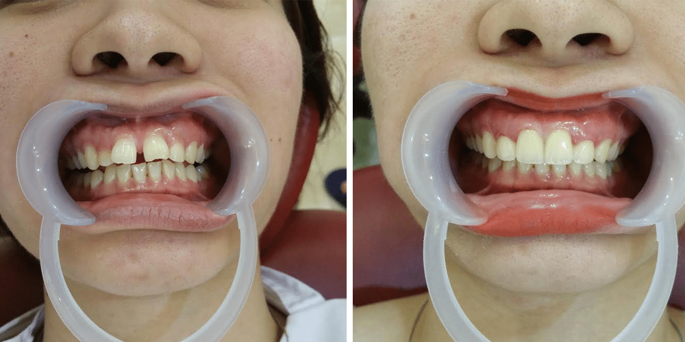 Bé trai 11 tuổi mọc răng thừa ngay giữa 2 răng cửa, bác sĩ làm điều này trong 2 năm để cứu trẻ - Ảnh 4.